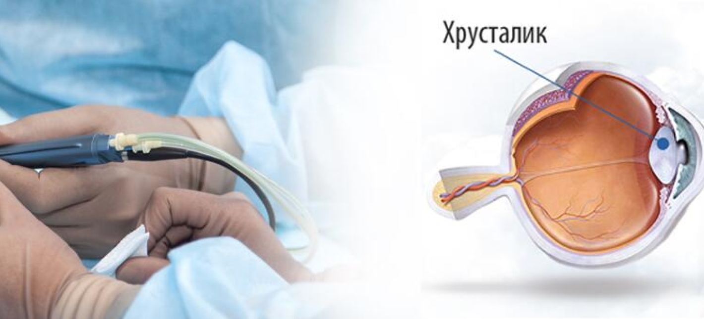 Факоэмульсификация катаракты/рефракционная ленсэктомия с имплантацией различных моделей интраокулярных линз (ИОЛ): монофокальные, торические, мультифокальные, мультифокальные торические