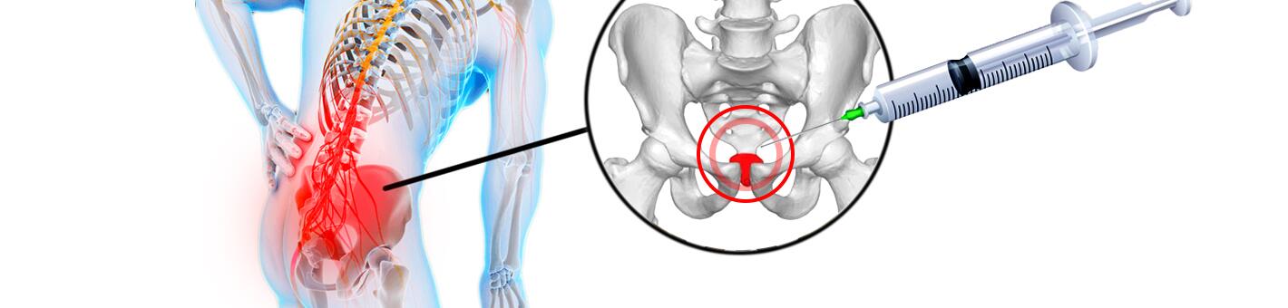 Копчиковые блокады при кокцигодинии