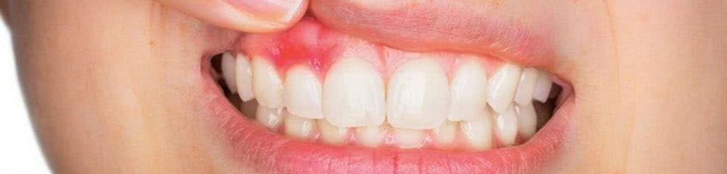 Цистэктомия (операция по удалению кисты зуба)