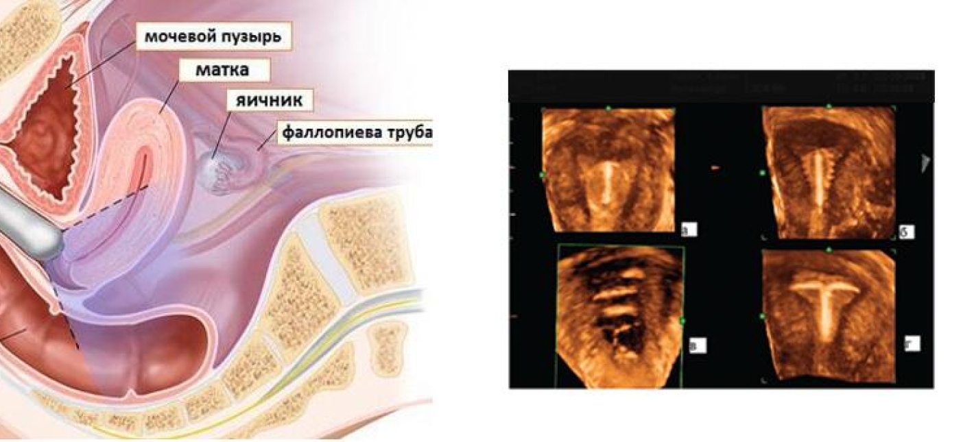 УЗИ матки и придатков (трансвагинально и трансабдоминально) с цифровой трехмерной реконструкцией. Дуплексное сканирование сосудов с цветным и энергетическим доплером (дети)