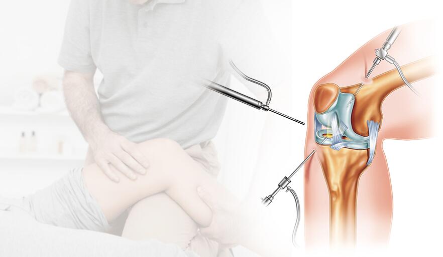 Операция по восстановлению коленного сустава. Операция на мениске артроскопия. Артроскопическая резекция мениска. Артроцентез коленного сустава. Операция артроскопия коленного сустава.