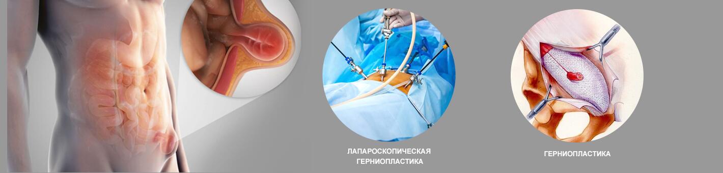 Хирургическое лечение паховой грыжи (герниопластика)