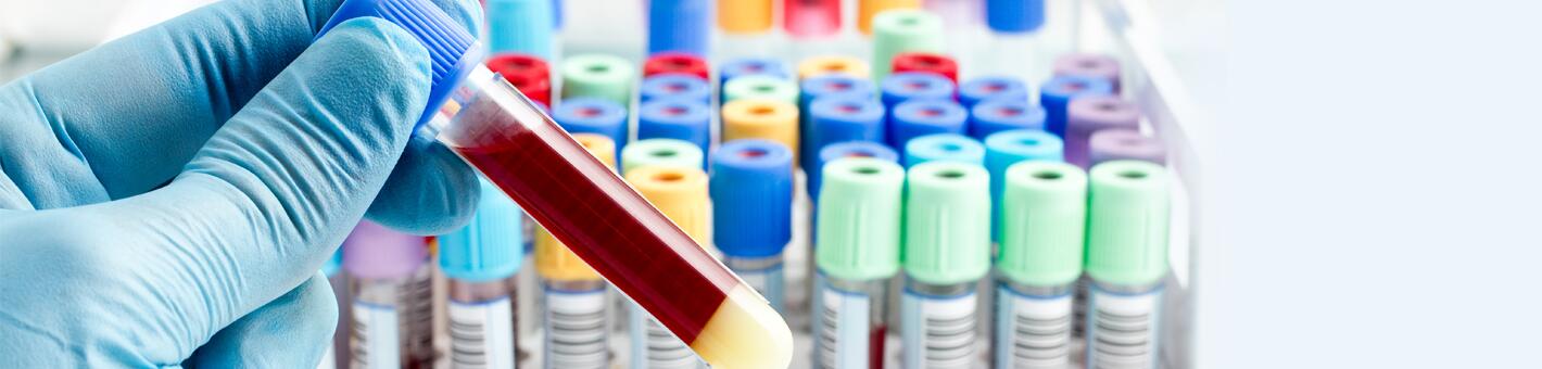 Аллерготестирование по крови: анализ крови на определение количества иммоноглобулина E