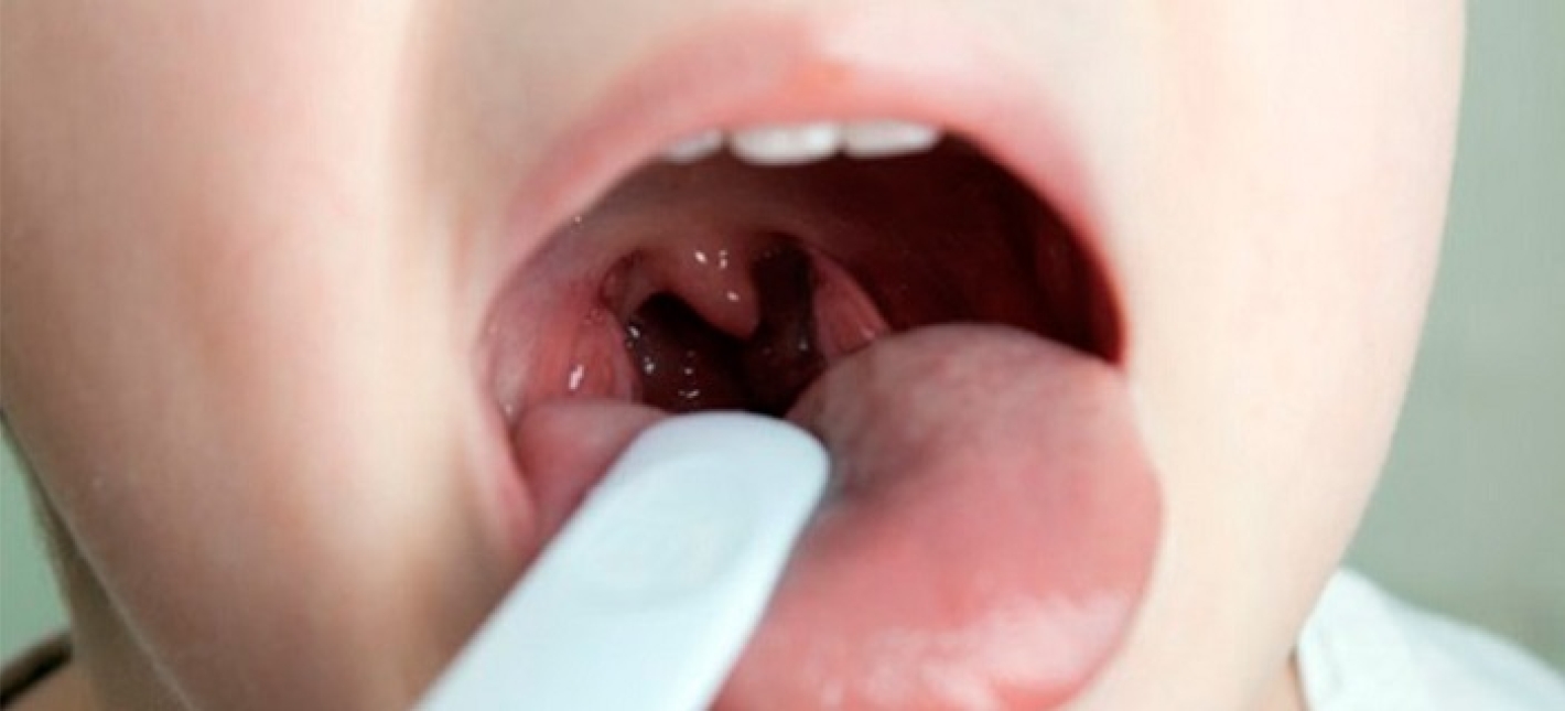 Тонзиллоаденотомия с эндоскопическим контролем, с использованием хирургического электрокоагулятора или радиоволнового аппарата Surgitron под наркозом