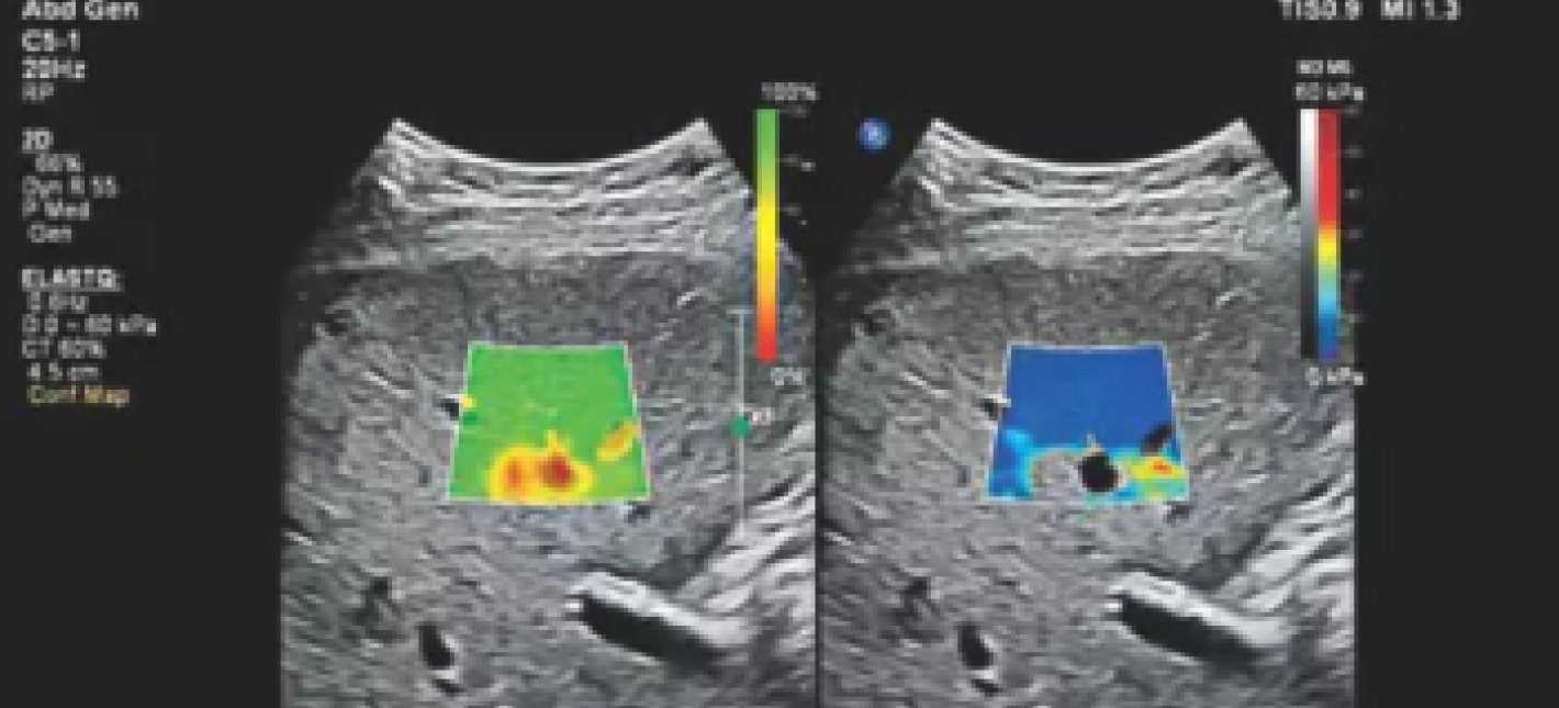Ультразвуковая эластография