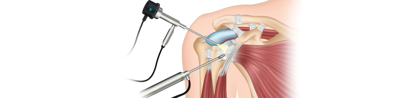 Артроскопия плечевого сустава