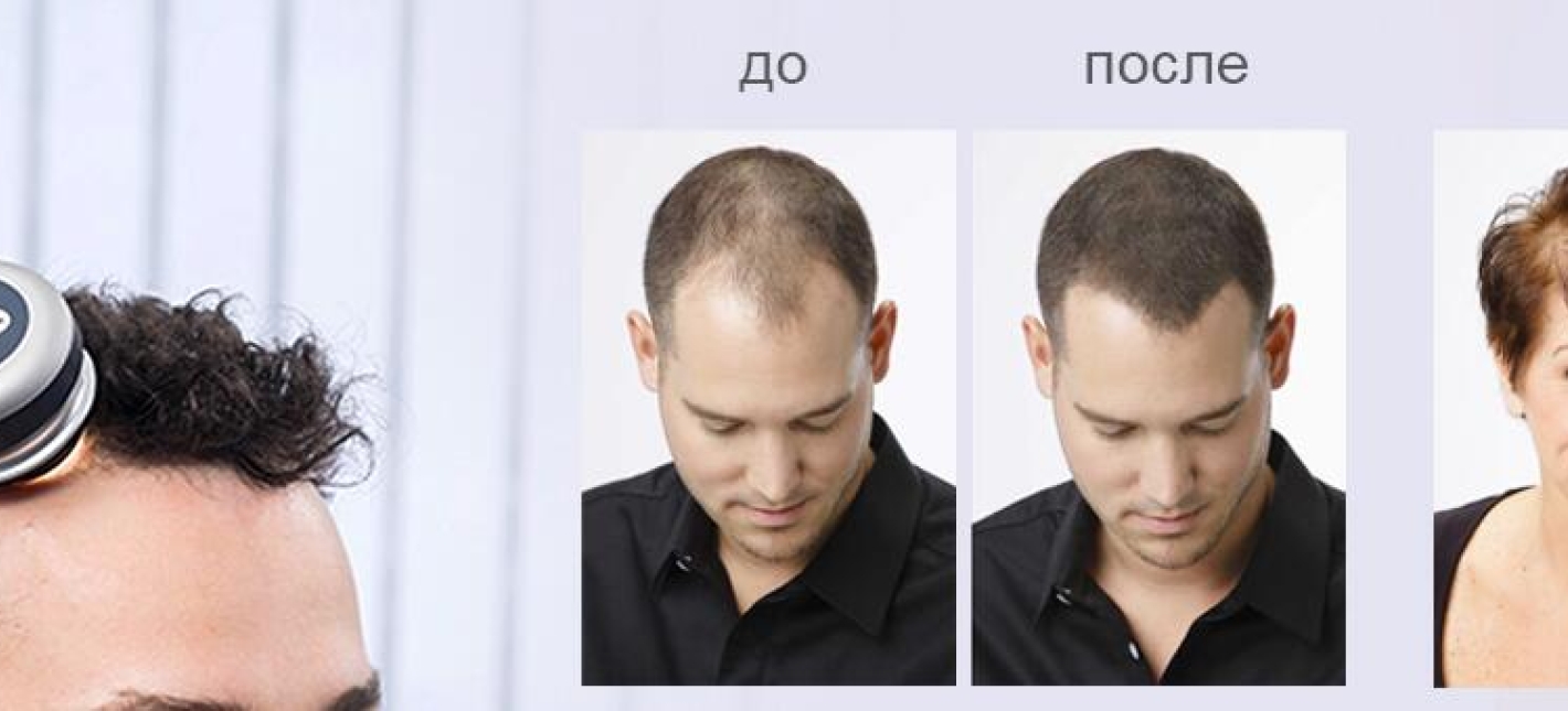 Трихоскопия