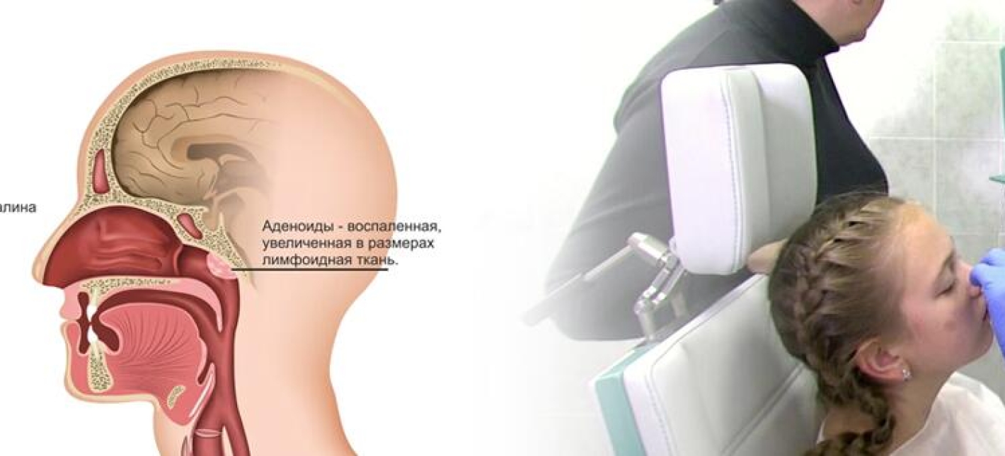 Аденотомия с эндоскопическим контролем и использованием хирургического лазера под наркозом