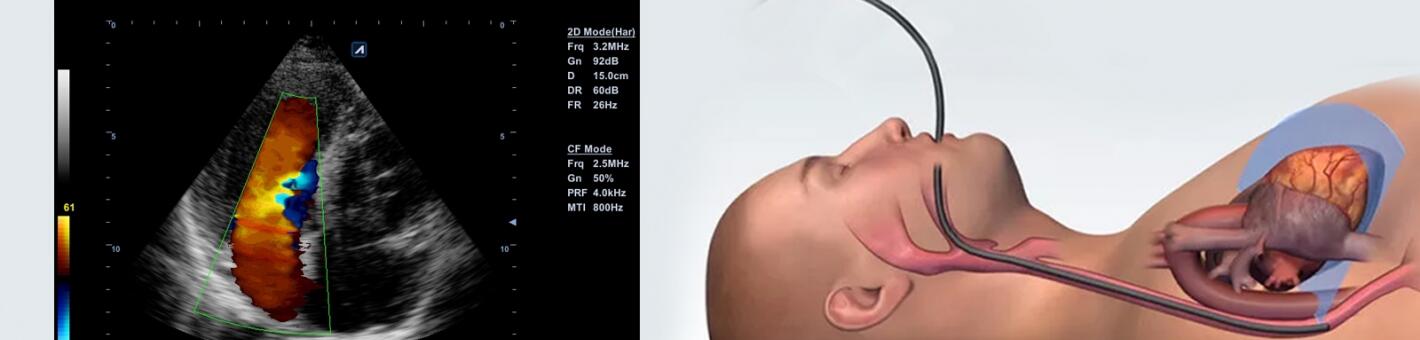 УЗИ: эхокардиография чреспищеводная с  доплерографией регионарного артериального бассейна 