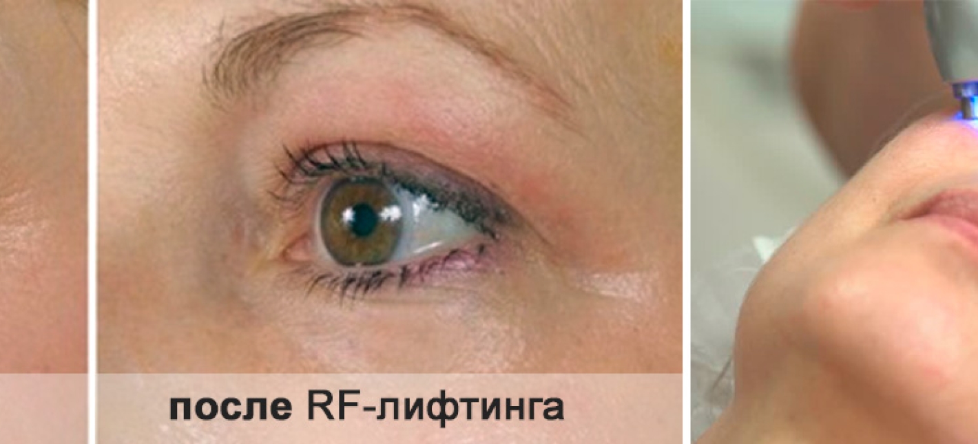 Радиочастотный лифтинг (RF-лифтинг)