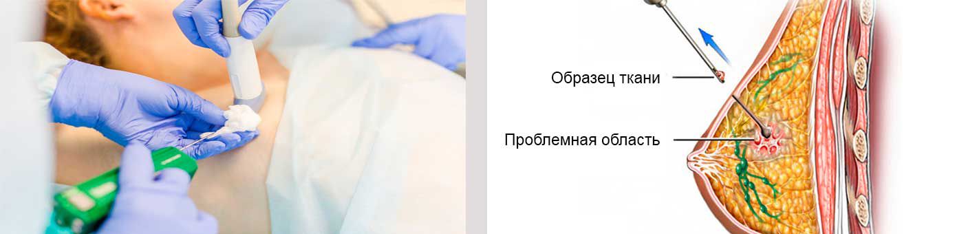 Тонкоигольная пункционная аспирационная биопсия образований молочной железы