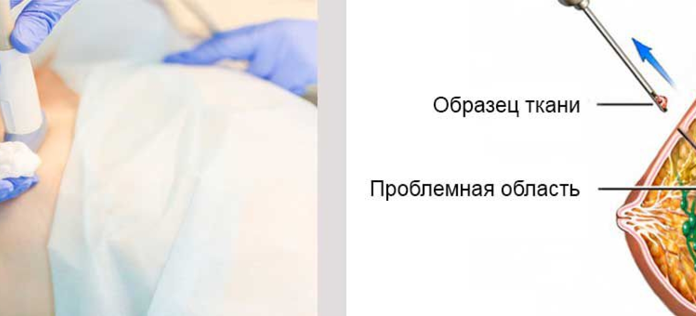 Тонкоигольная пункционная аспирационная биопсия образований молочной железы