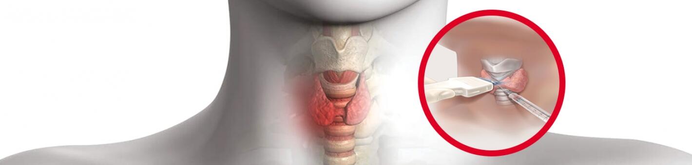 Тонкоигольная аспирационная биопсия  щитовидной железы под УЗ-контролем