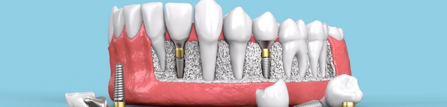Имплантация зубов
