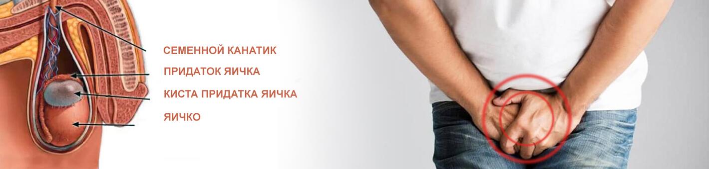 Удаление кисты придатка яичка